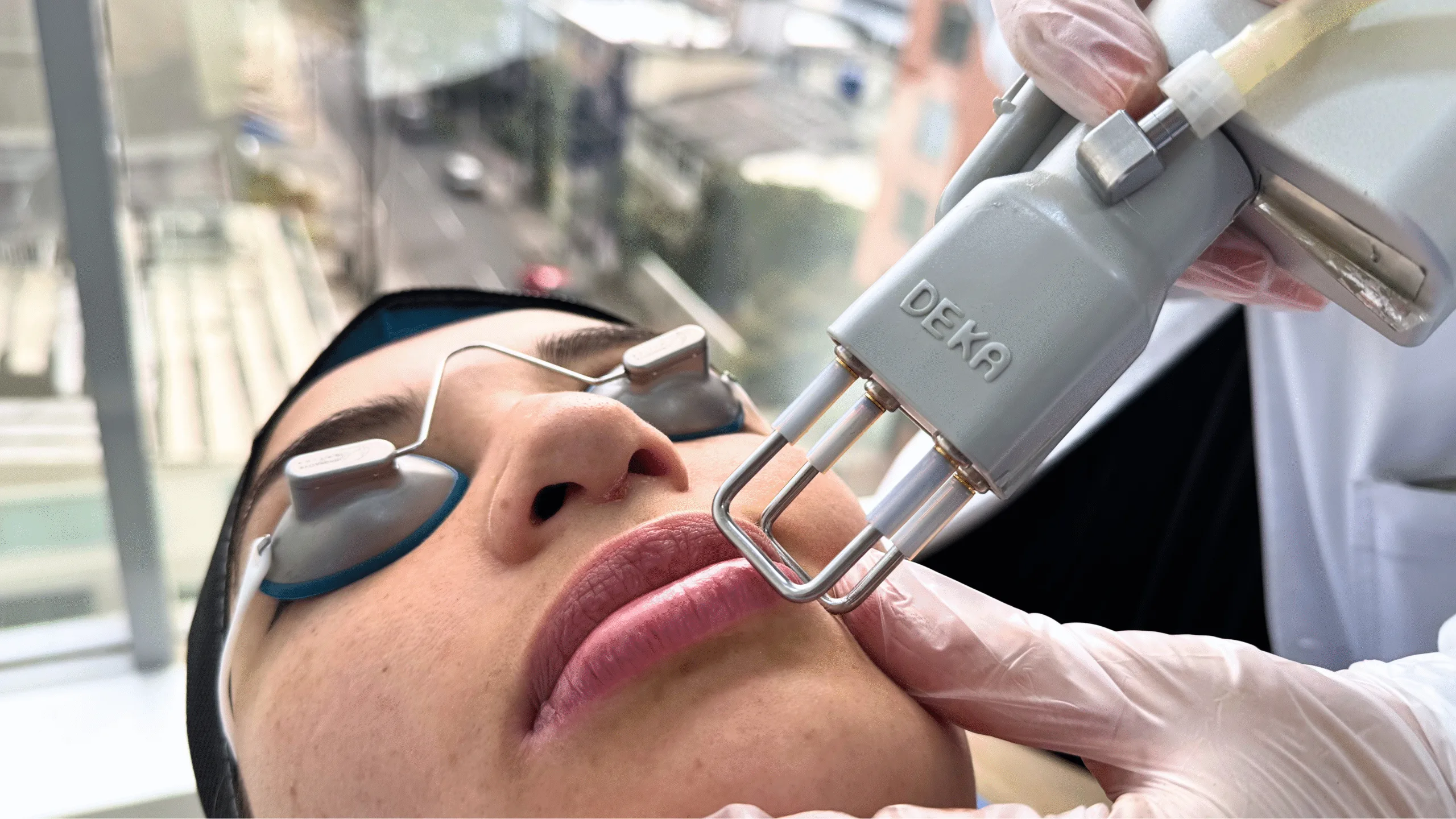 flacidez facial con laser co2
